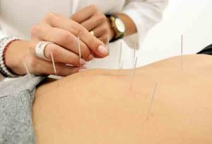 A acupuntura é o método mais conhecido (Foto: Divulgação)