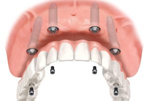 dentadura-fixa